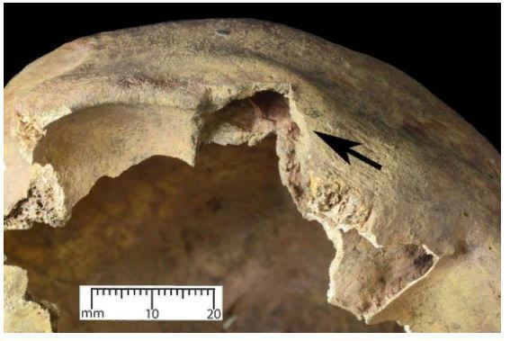 Рана квадратной формы над глазом в черепе