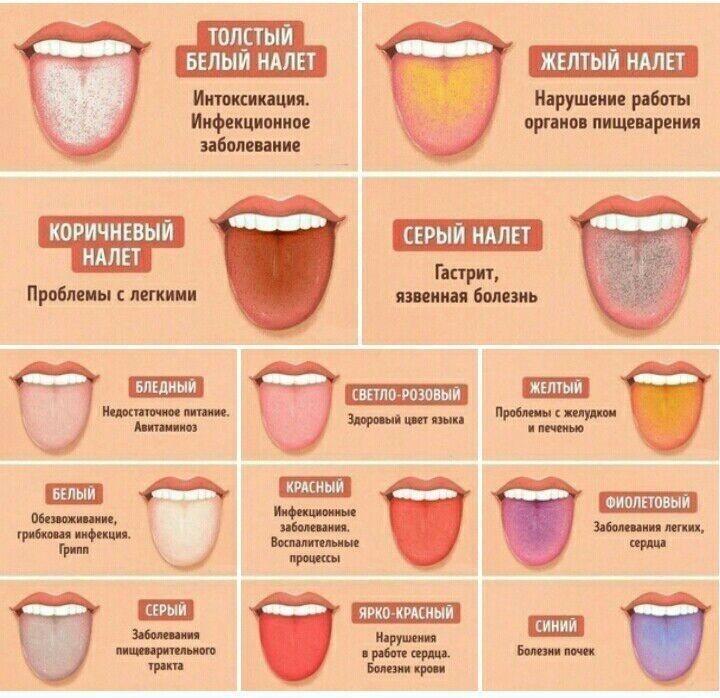 А вот относительно цвета языка и сопровождающих болезней — все правда А вот относительно цвета языка и сопровождающих болезней — все правда